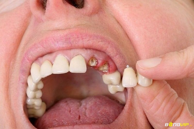 Gãy nhiều răng trong mơ – dấu hiệu tâm lý quá tải và cảm giác mất kiểm soát toàn diện trong đời sống cá nhân