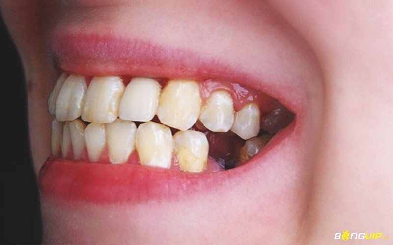 Răng hàm gãy – biểu tượng của áp lực đè nặng từ công việc và trách nhiệm khiến bạn không thể “nghiền nát” nỗi lo cuộc sống