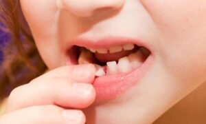 Mơ gãy răng là điềm báo gì? Giải mã chi tiết từ chuyên gia