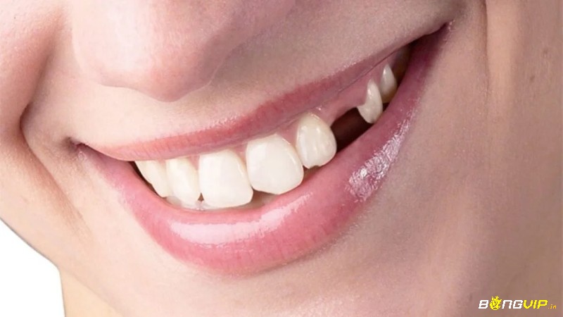 Giải mã giấc mơ thấy gãy răng là cơ hội làm giàu 