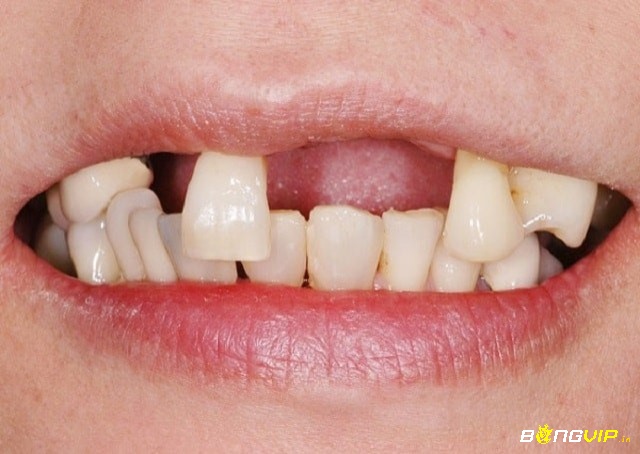 Chiêm bao gãy răng cửa nhắc nhở bạn về sức khỏe 